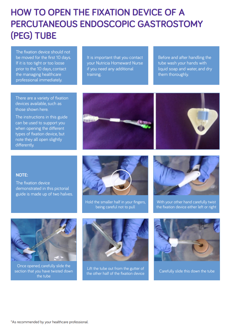 How to open the fixation device of a PEG